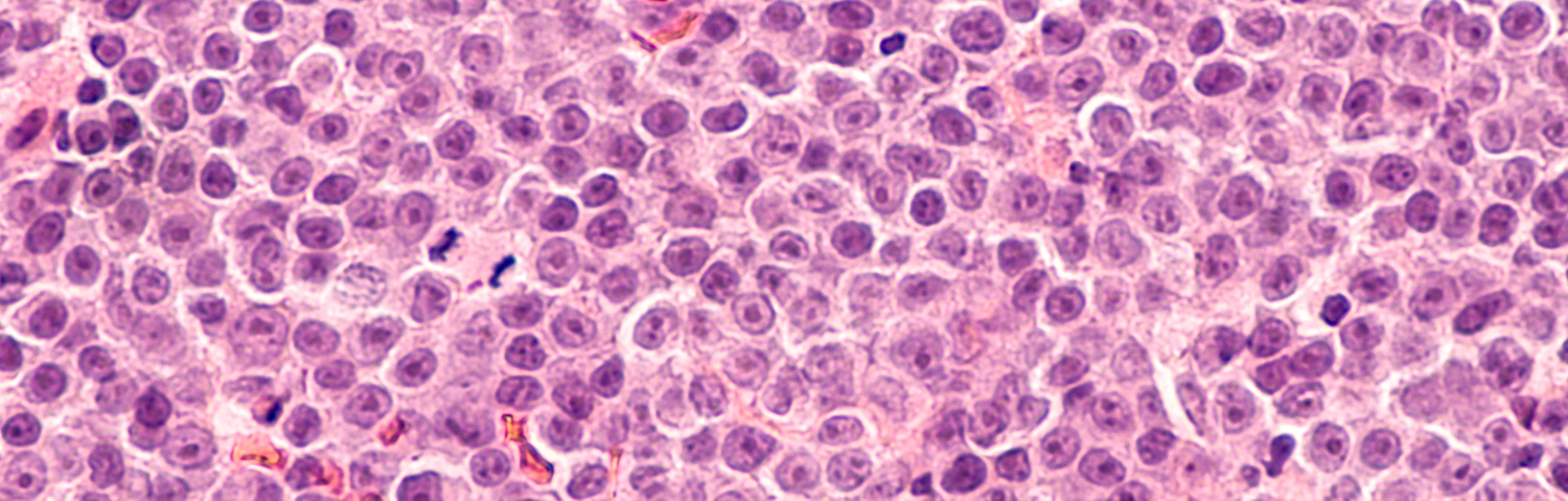 Lymphoma cells as seen through a microscope