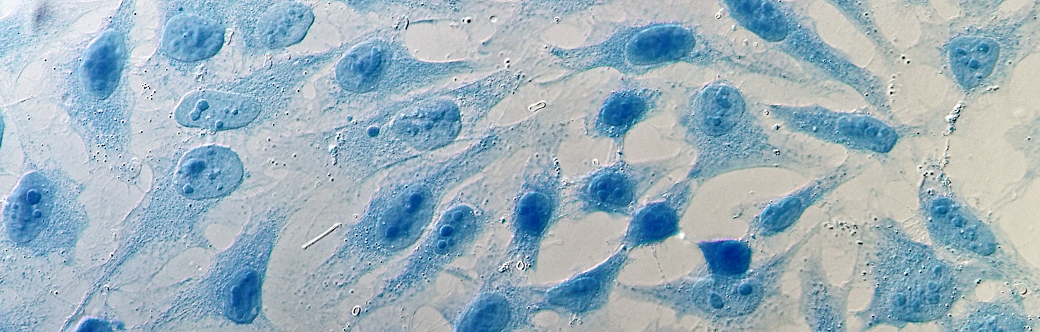 Cervical cancer cells under a microscope
