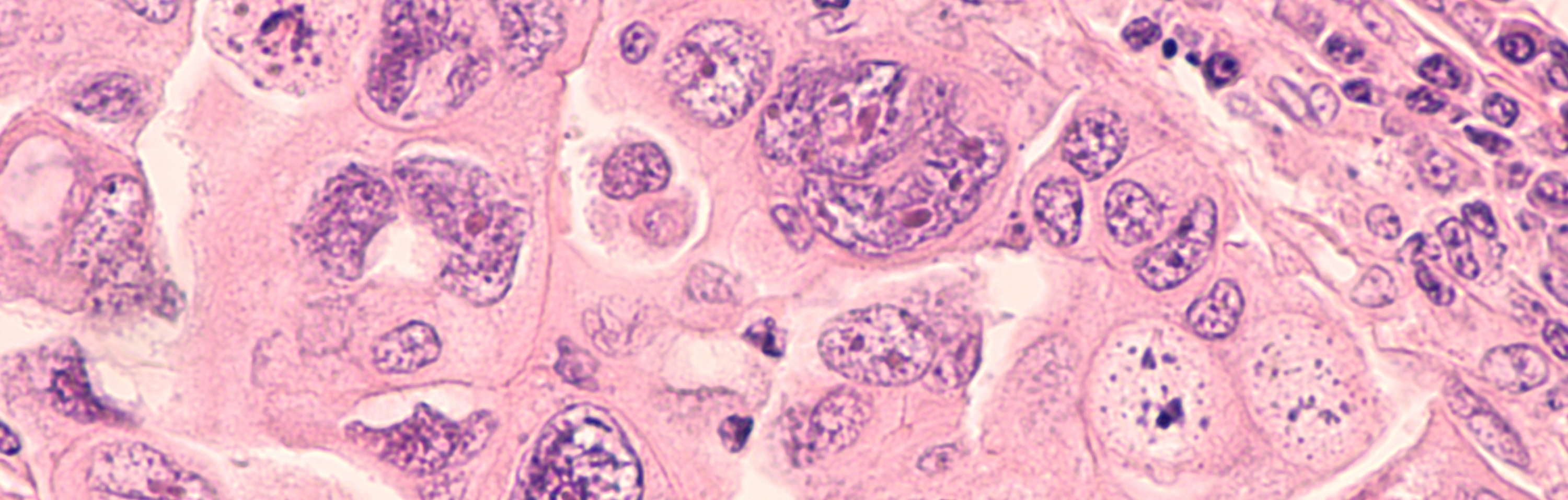 Ovarian cancer cells as seen under a microscope