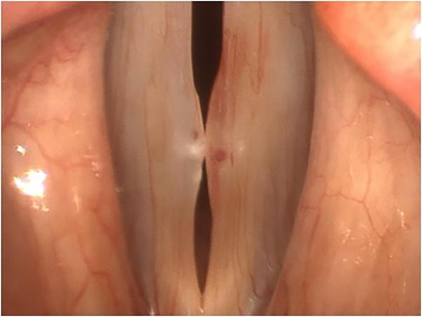 This image shows a resolving vocal fold hemorrhage on the left vocal fold (right in the picture), visible as a darker blush of resorbing blood, in a patient with bilateral pseudocysts. A varix (the larger red dot), or dilated blood vessel, is visible in t