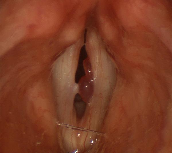 This polyp has two lobes and interferes with vocal fold closure and vibration during voicing.