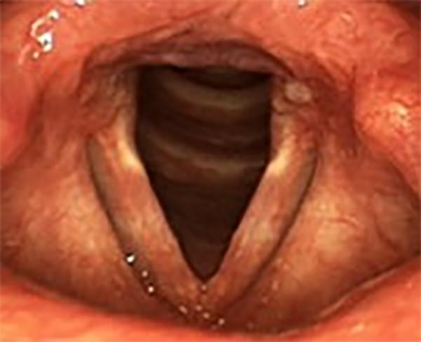A milder case of reflux with some swelling of the tissue at the back of the larynx and reddening of the vocal folds