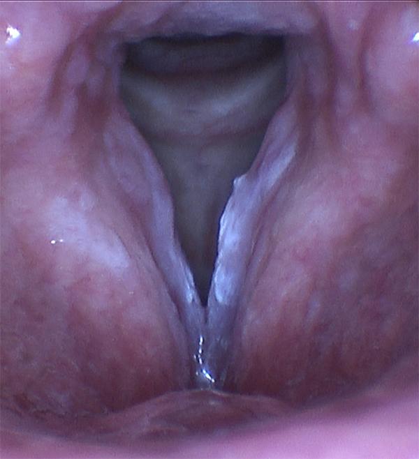 Leukoplakia affecting both vocal folds, and predominantly the left (right side on the picture). This patient is a heavy smoker who presented with voice changes deteriorating over several years.