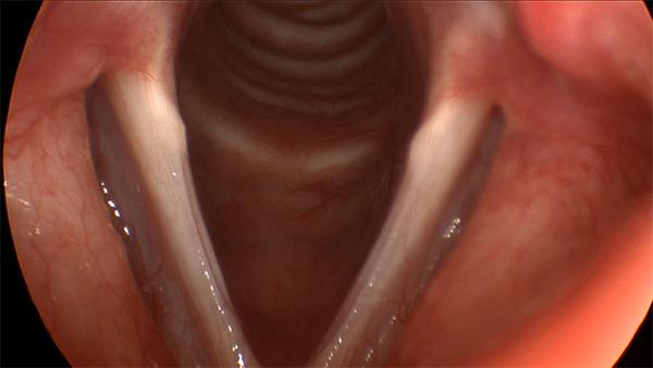 This is the typical appearance of sulcus vergeture. Grooves along the edge of both vocal folds which gives the appearance of tissue being scooped out of the vocal fold.