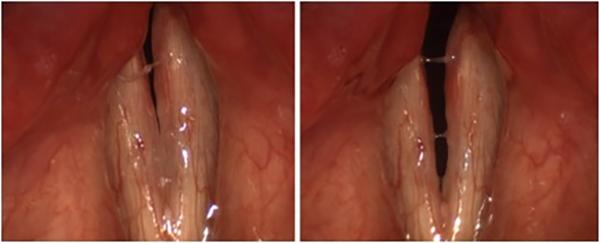 This shows the full range of motion of the vocal folds in a patient with bilateral vocal fold paralysis after thyroid surgery. The vocal folds are closed for voicing at left, and open for breathing at right.