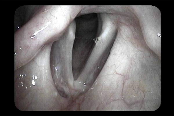 Vocal Fold Injection