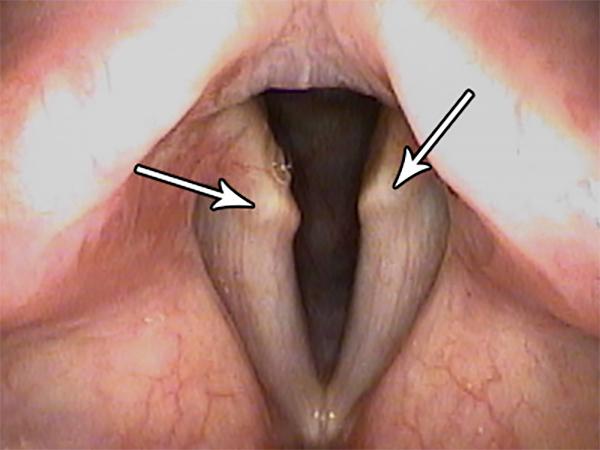 Normal Projections of Cartilage Appear to Stand Out as Abnormal Masses in These Thinned Vocal Folds