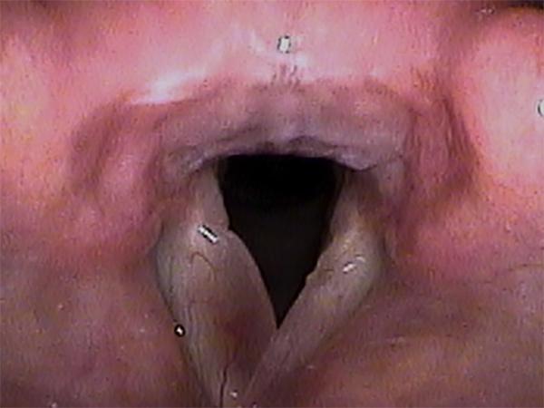 Reinke’s edema involves the vocal fold on the left of the image, making it appear very swollen.