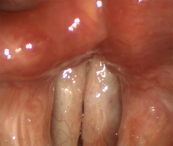 This patient has scar of both vocal folds after more than a dozen surgeries for papilloma.