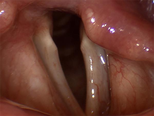 In this patient with longstanding vocal fold paralysis, the paralyzed vocal fold has lost muscle mass and has become thin and atrophic.