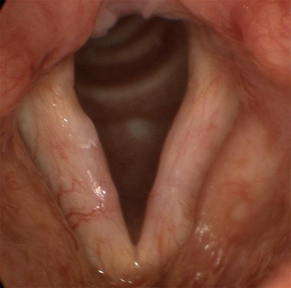 Scar is very difficult to show in still images. The bloodshot, unusually white vocal folds shown here are typical for diffuse scar, in this case after sloppy surgery for a pair of vocal fold polyps.