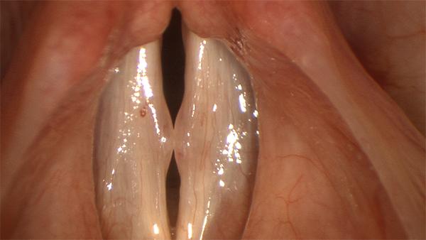 Another case of pseudocysts of both vocal folds shows how these interfere with the dynamics of vocal fold closure during voicing.