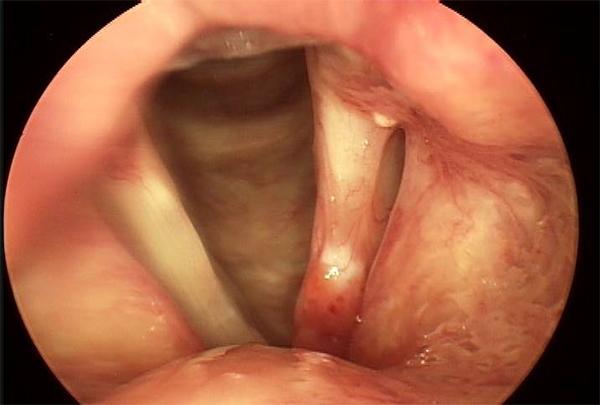 The Red Area at the Front of the Left Vocal Cord (Right in the Image) is an Early Cancer Which is Curable with Limited Surgery
