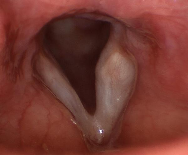 The vocal fold on the left of the image has a linear scar from an injury caused by the insertion of a breathing tube.