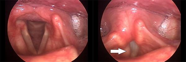 Vocal Fold Paresis