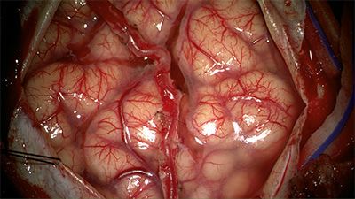 Indirect bypass for Moyamoya