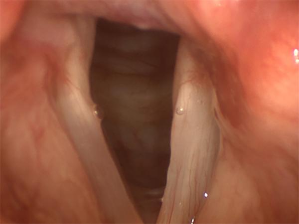 The vocal fold on the right of the image is paralyzed after a lung operation. This is the typical appearance of a paralyzed vocal fold during quiet breathing.