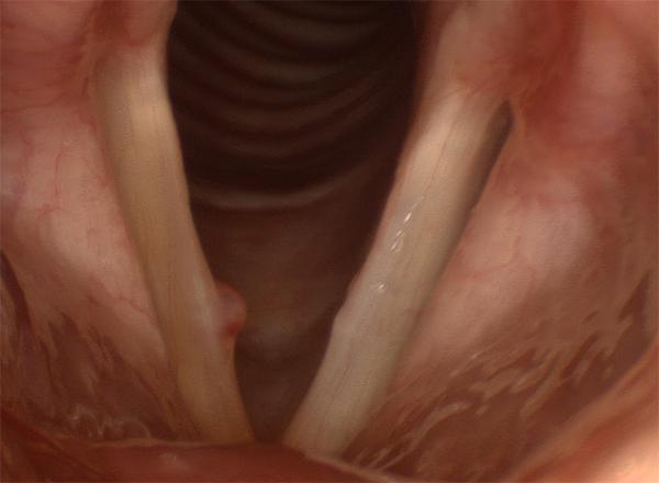  a red, well-demarcated mid-vocal fold mass.