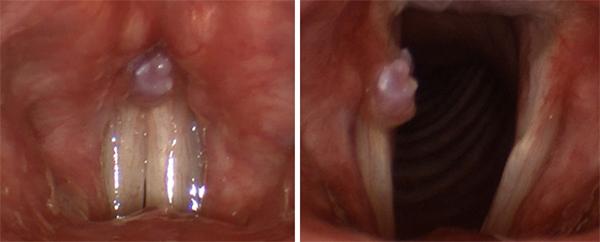 A granuloma is growing over the vocal process of the vocal fold. Somewhat hidden during voicing (left), it is obvious when the vocal folds open (right). The location shows how the area is traumatized when the vocal folds come into contact.