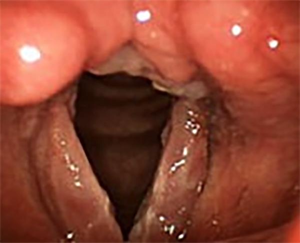 Redness, swelling and thickening of the mucosa, involving the back of the larynx (top of picture) and both vocal folds, can be seen in this case of a nonsmoker with severe reflux.