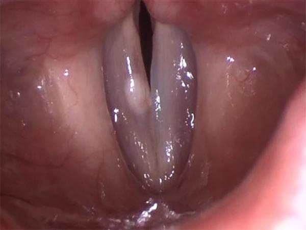 An Ovoid Cyst is Visible Underneath the Covering (&quot;Epithelium&quot;) of the Vocal Fold
