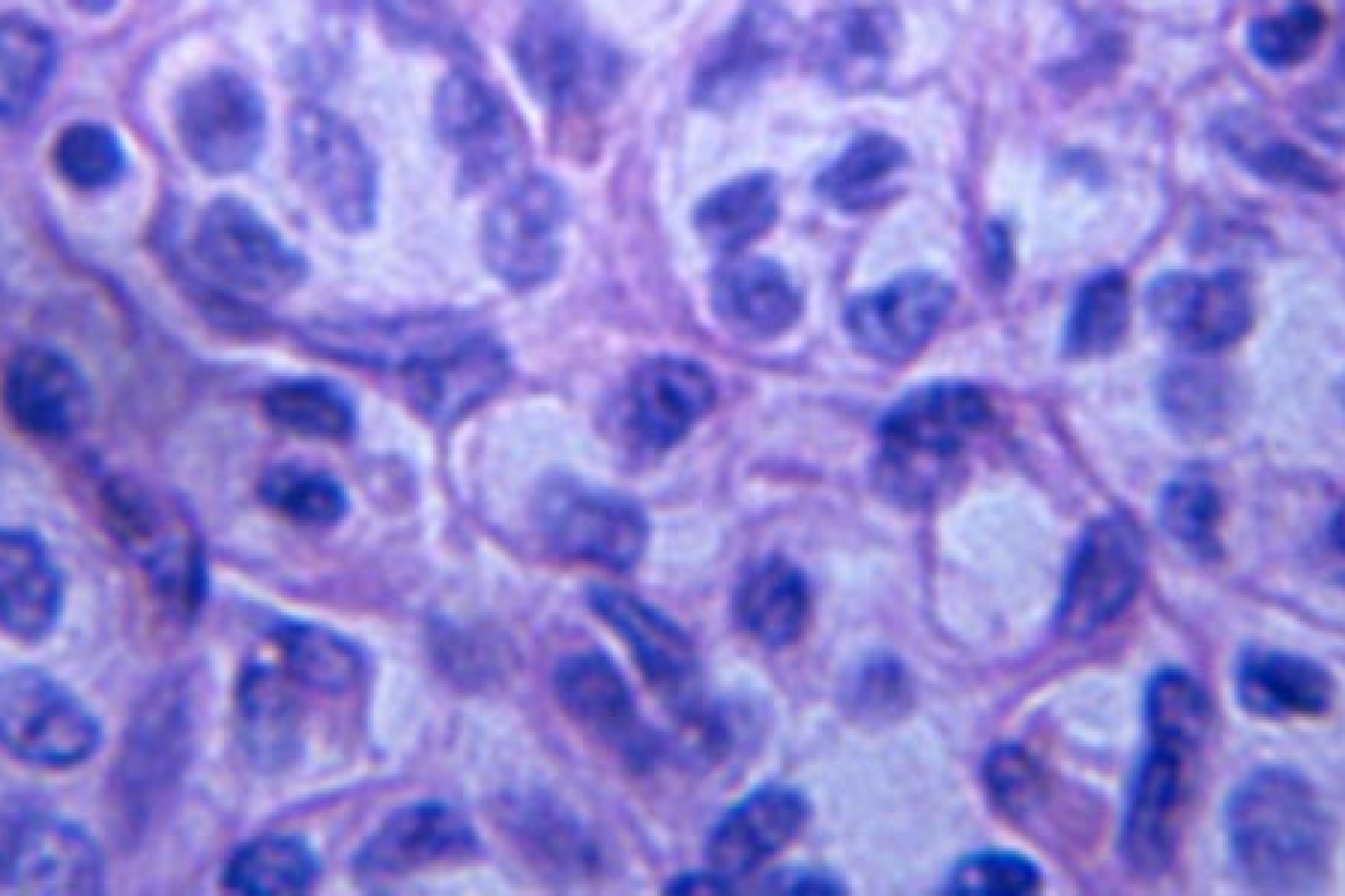 Microscopic Image of Kidney Carcinoma