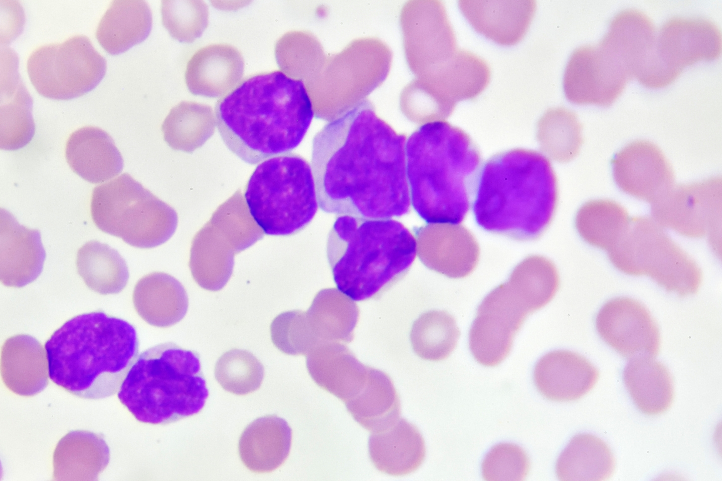Acute myeloid leukemia cells under a microscope