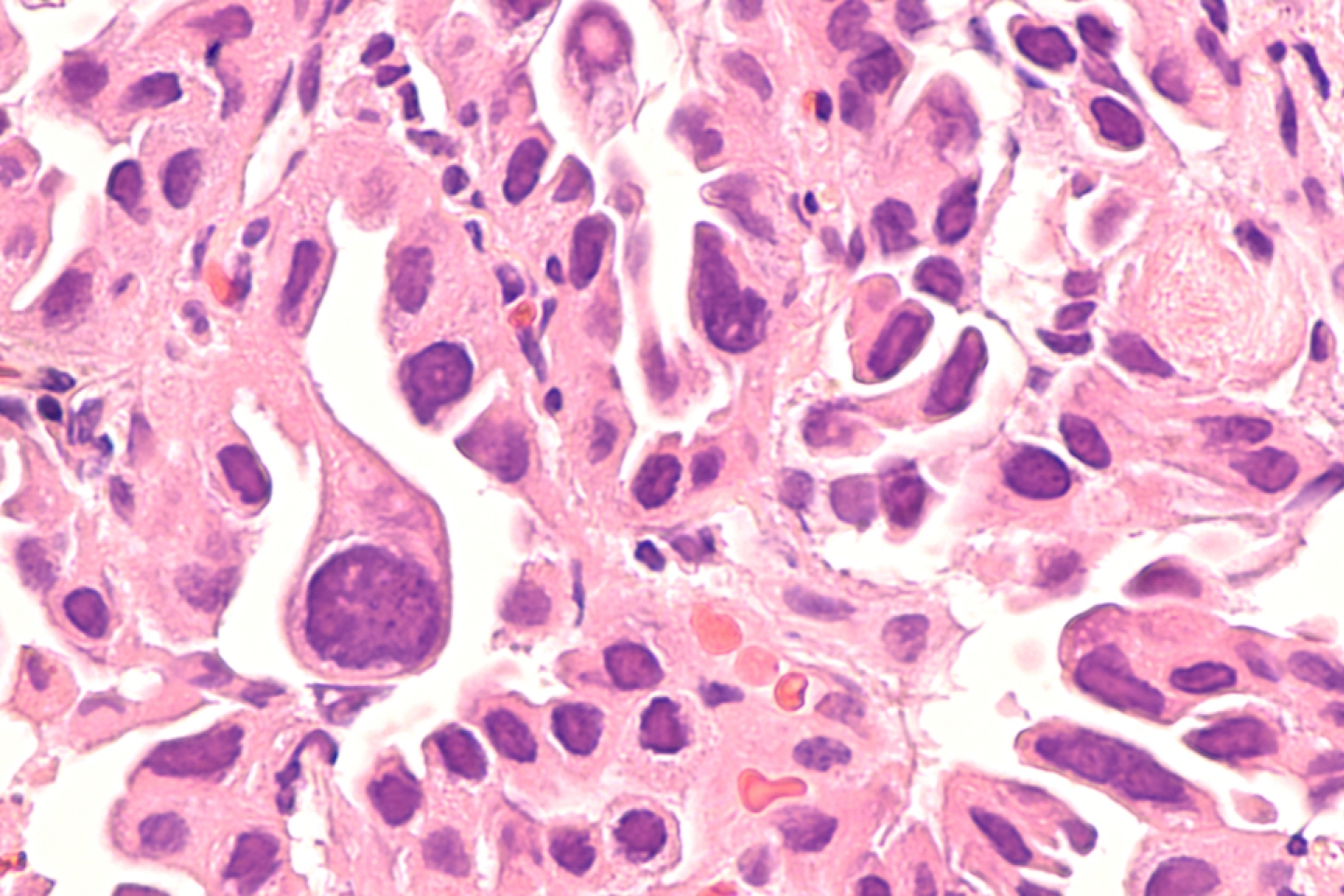 Lung cancer - adenocarcinoma: