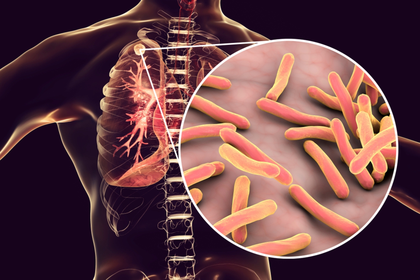 tuberculosis in lungs