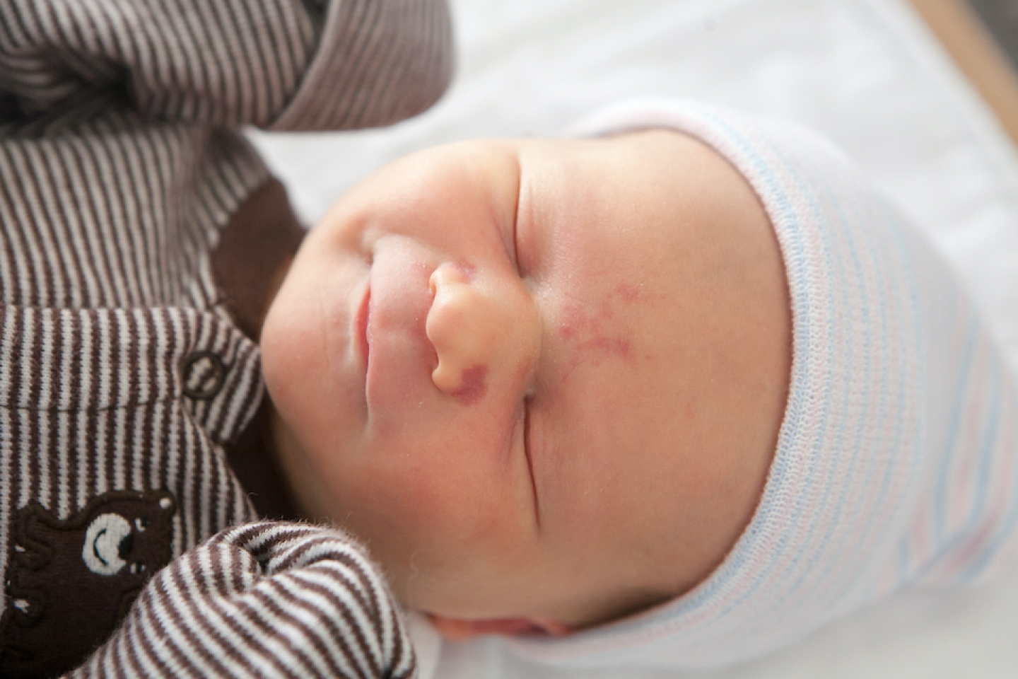 baby with birthmark