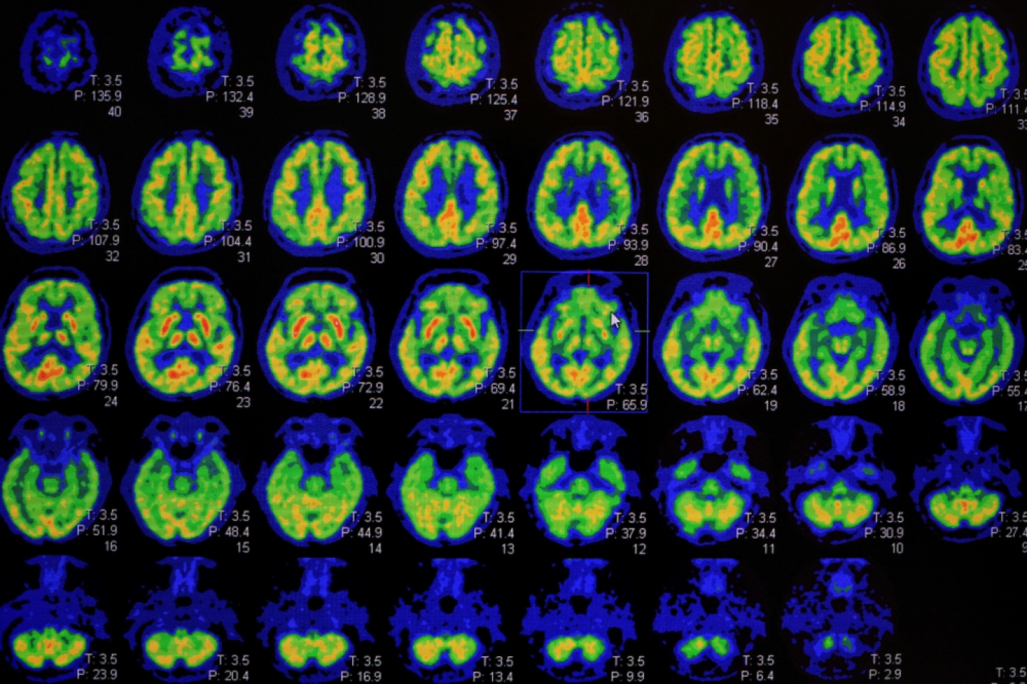 PET CT scan of Human Brain