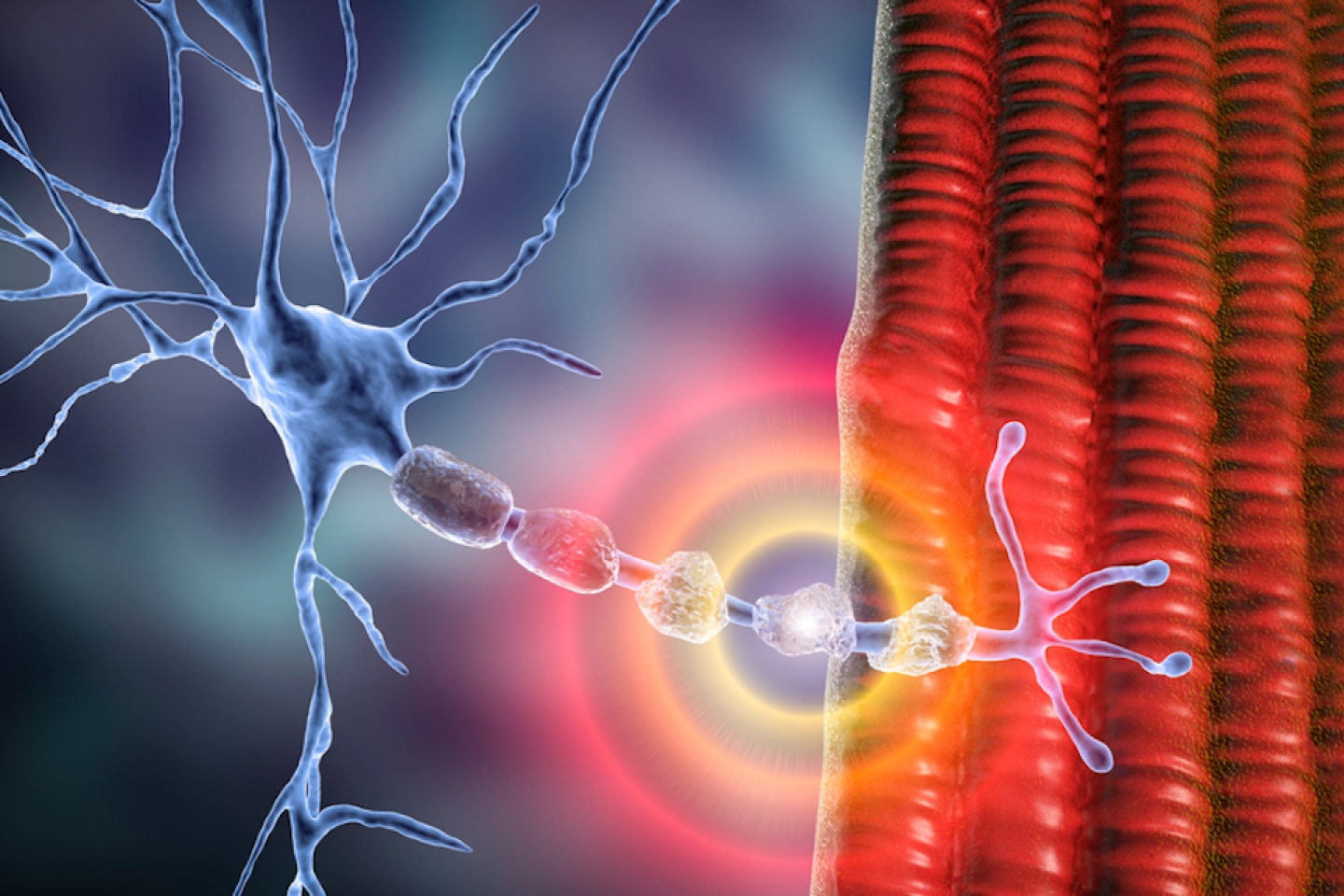 Demyelination of neuron, the damage of the neuron myelin sheath seen in demyelinating diseases, 3D illustration.