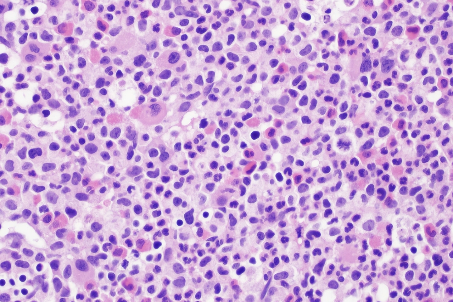 Haematolymphoid Tumours. Myeloproliferative neoplasms.