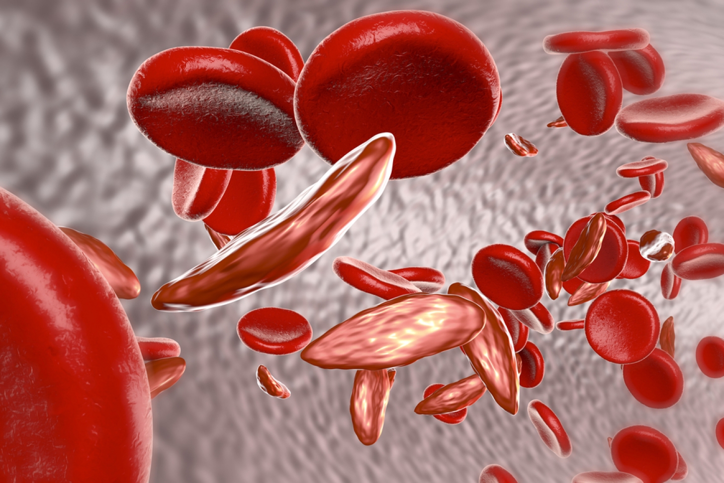 3D illustration of sickle cell disease