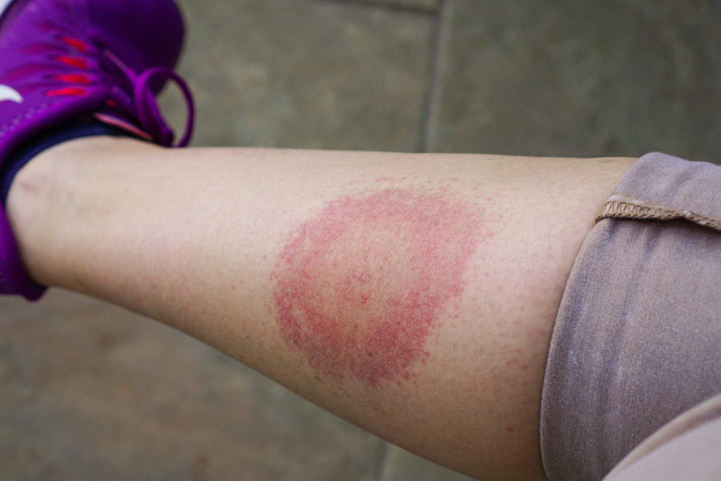 Lyme disease, Borreliosis or Borrelia, typical lyme rash, spot. A person, leg bitten by a deer tick.