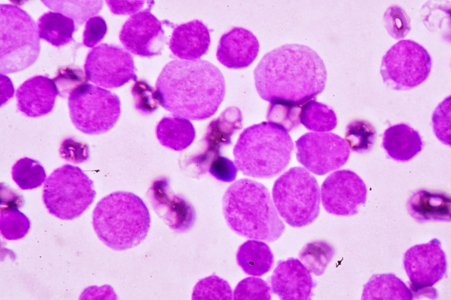 Blood smear under microscopy showing adult acute myeloid leukemia.