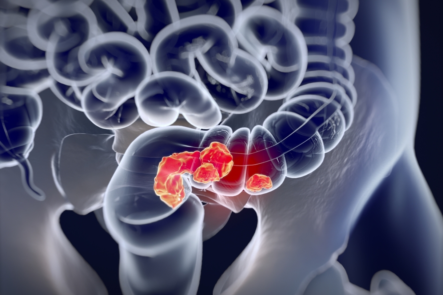 Colorectal cancer,medical anatomical illustration.3d illustration