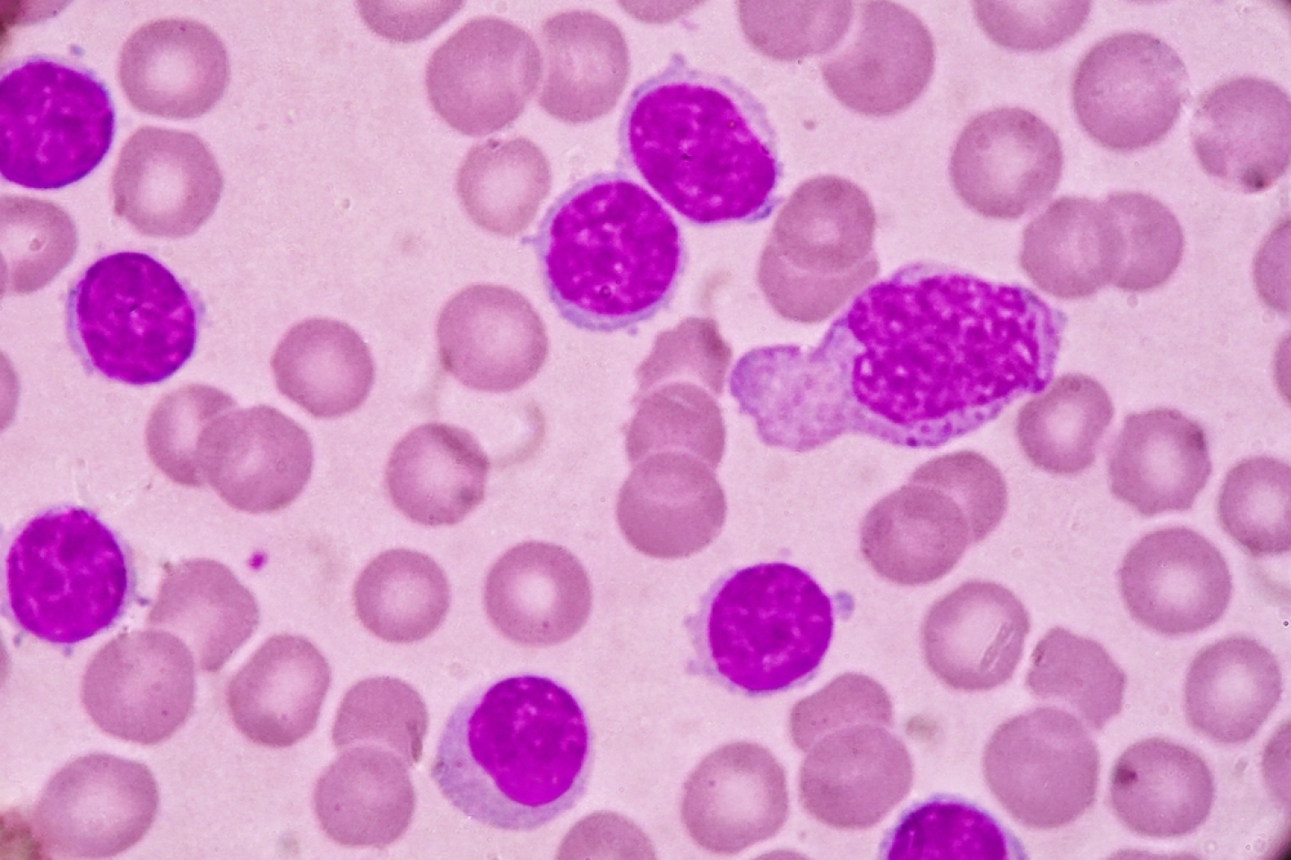 Blood smear under microscopy showing chronic lymphoblastic leukemia (CLL)