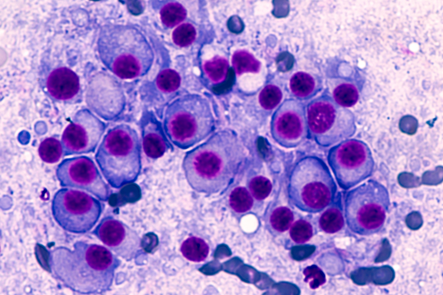 Multiple myeloma