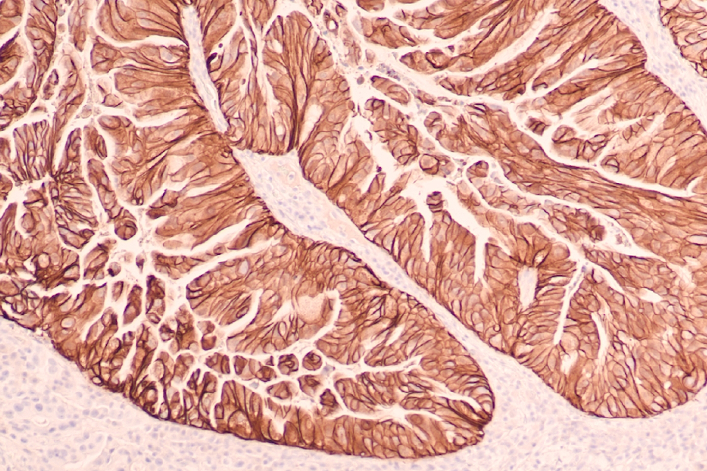 Stomach Cancer Pathology Research: Immunohistochemistry for HER2 shows positive cell membrane staining in this gastric adenocarcinoma. Targeted therapy with Herceptin (trastuzumab) may be beneficial.