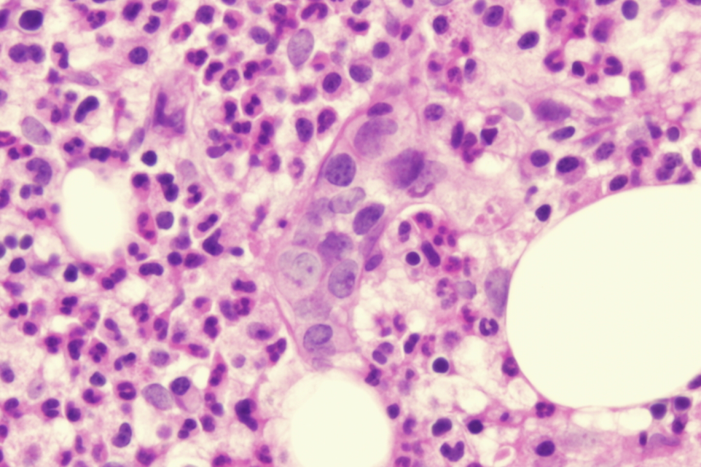 Intravascular large B cell lymphoma
