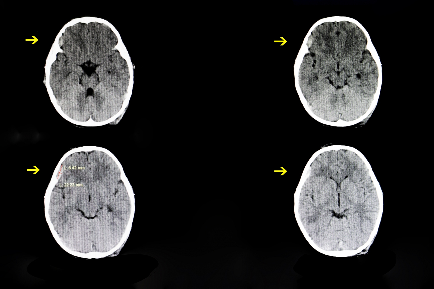 Brain scan that shows a subdural hematoma.