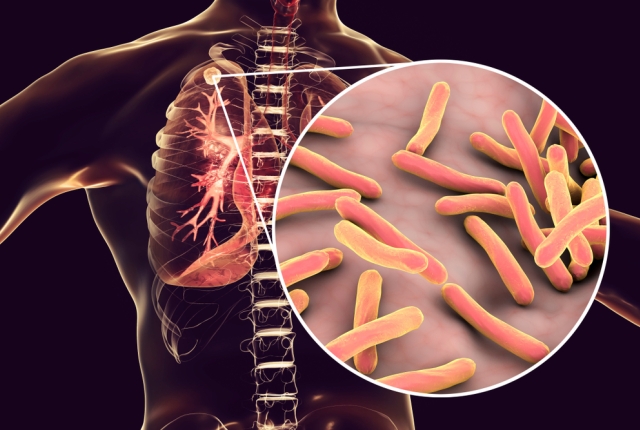 tuberculosis in lungs