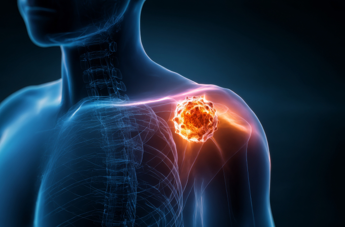 Tumor