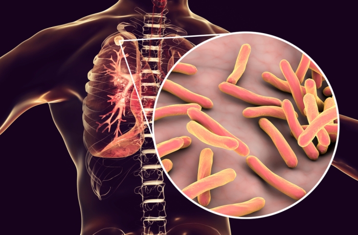 tuberculosis in lungs