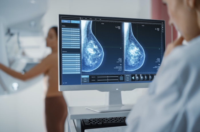 Woman Standing Topless Undergoing Mammography Screening Procedure. Screen Showing the Mammogram Scans of Dense Breast Tissues.