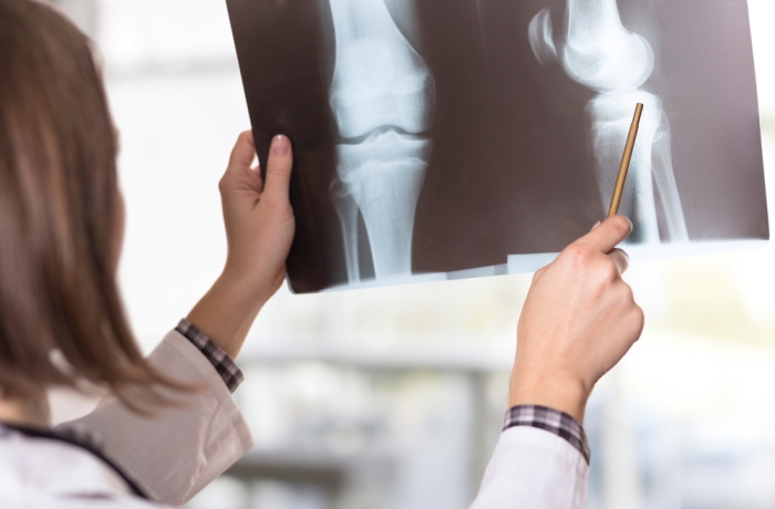 Young female doctor looking at the x-ray picture of knee injury in a hospital