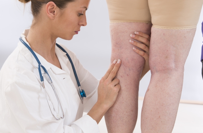 doctor showing varicose veins from an elderly woman