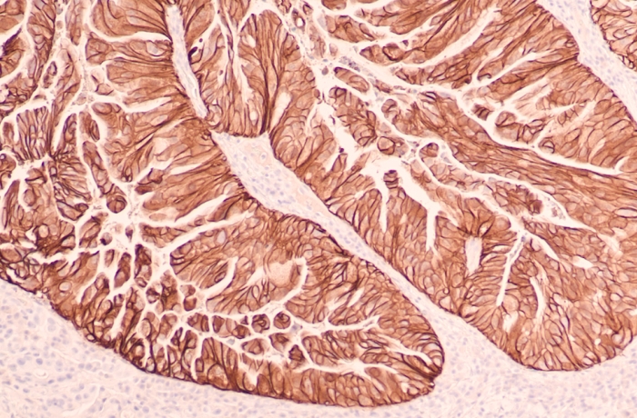 Stomach Cancer Pathology Research: Immunohistochemistry for HER2 shows positive cell membrane staining in this gastric adenocarcinoma. Targeted therapy with Herceptin (trastuzumab) may be beneficial.