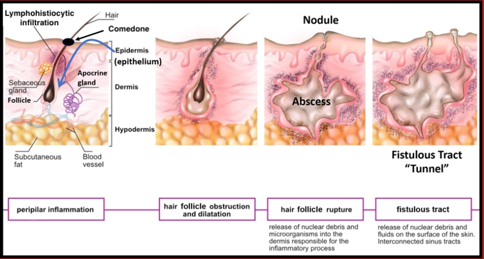 Hidradenitis Suppurativa